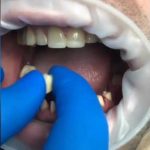 Керамические коронки (протезирование зубов)