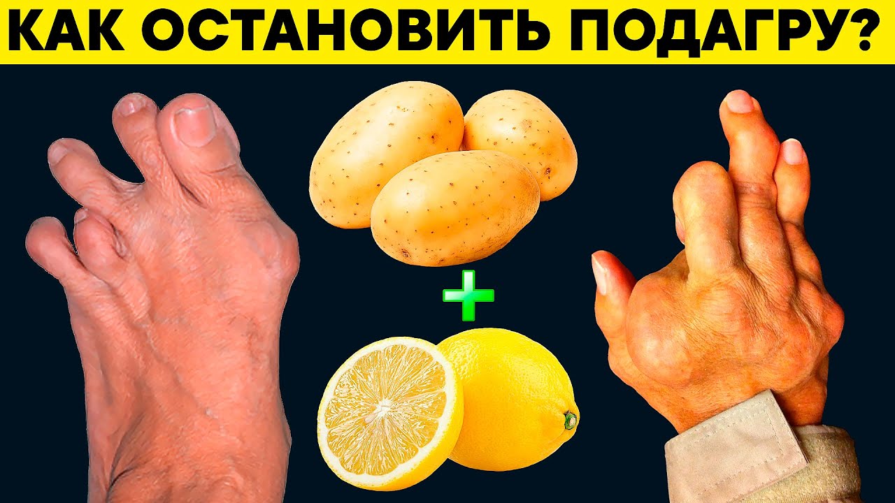 Всего 2 продукта моментально растворят КРИСТАЛЛЫ МОЧЕВОЙ КИСЛОТЫ. Продукты от ПОДАГРЫ и АРТРИТА